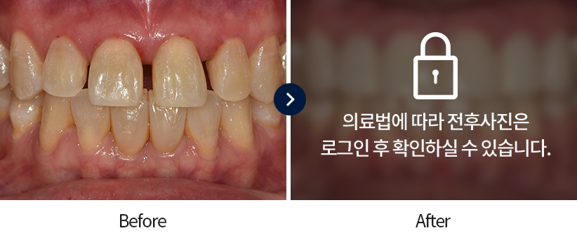 무삭제-라미네이트-전후사진1